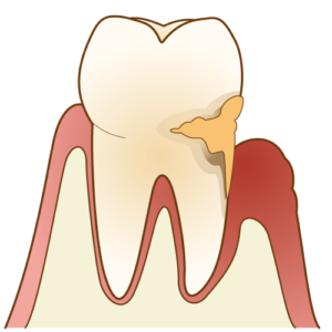 歯周病の画像